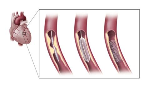 Стенирование сосудов сердца