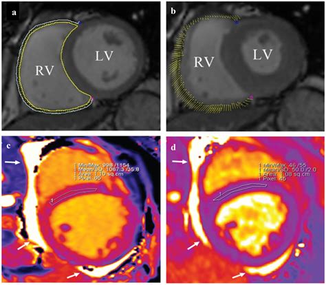 A B Cardiac MRI Images In A Patient With Normal Heart Function This