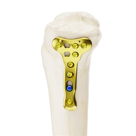 PROXIMAL TIBIA AFFINITY – Industrias Medicas Sampedro – EN