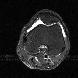 Musculoskeletal Radiology: Chondromalacia patella