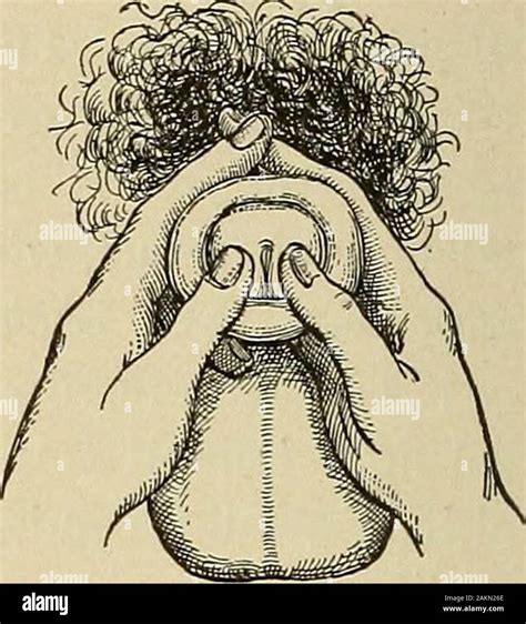 Paraphimosis hi-res stock photography and images - Alamy