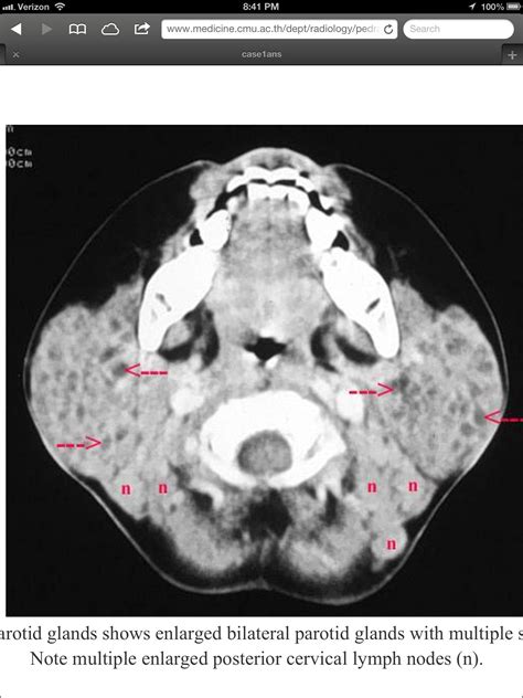 Hiv Lymphoma Epithelial Cysts With Adenopathy Sjogrens Parotid Gland