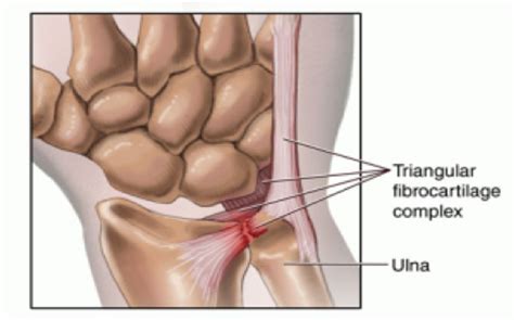 Tfcc Injury And Hand Therapy Hand Therapy Academy