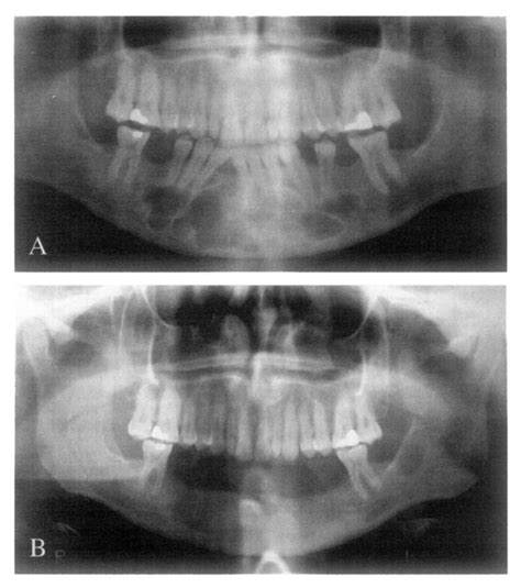 A Orthopantomogram Shows Multilocular Odontogenic Keratocyst In