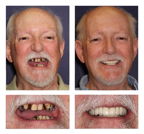 Affordable Dentures In Vero Beach Florida Vero Dental Spa