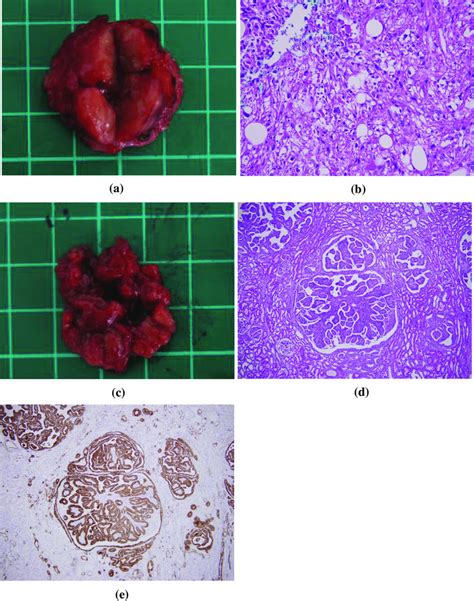 Pathology Of Renal Adenomatosis And Epithelioid Angiomyolipoma Obtained