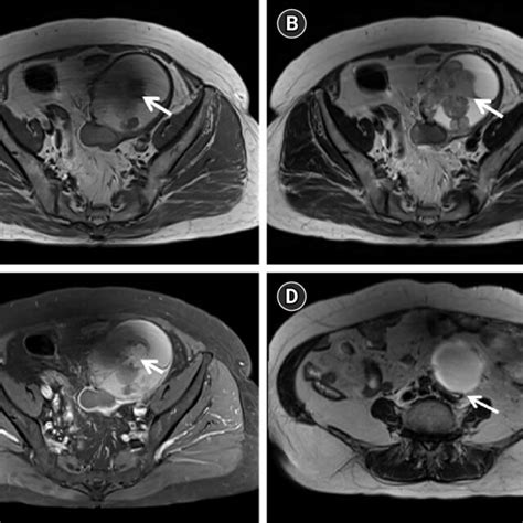 Magnetic Resonance Images Axial T1 Weighted A And T2 Weighted B