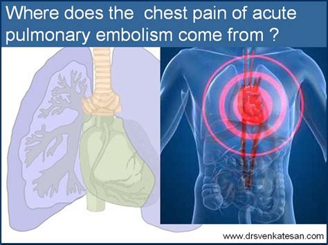 Anatomy Of Chest Pain