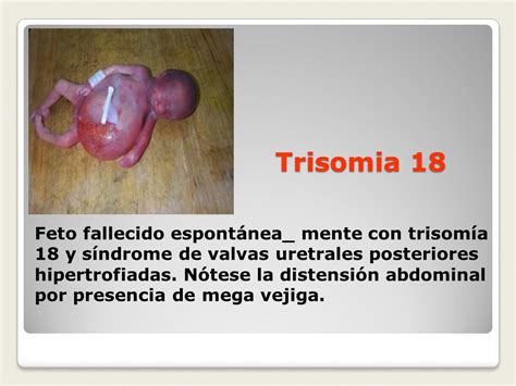 Med 031 Genetica Medica Anomalias Cromosomicas