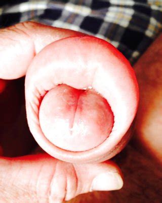 Huge Swollen Foreskin Brutal Pump Severe Bruising Porn Pictures XXX