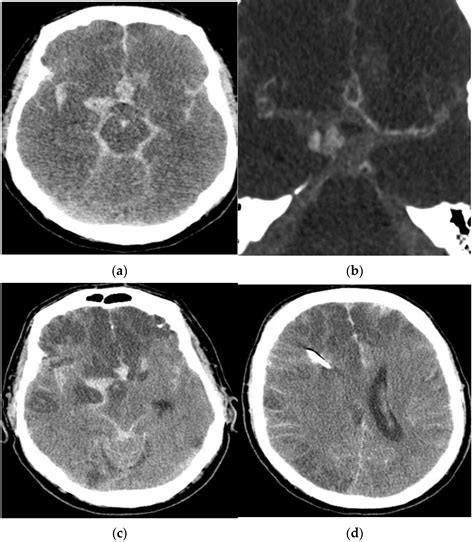 Jcm Free Full Text Vasospasm Related Death After Aneurysmal Subarachnoid Hemorrhage A