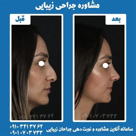 جراحی زیبایی بینی عکس ویسگون