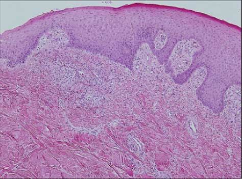 Skin Biopsy Specimen From The Ulcer Edge Shows Acanthosis Perivascular