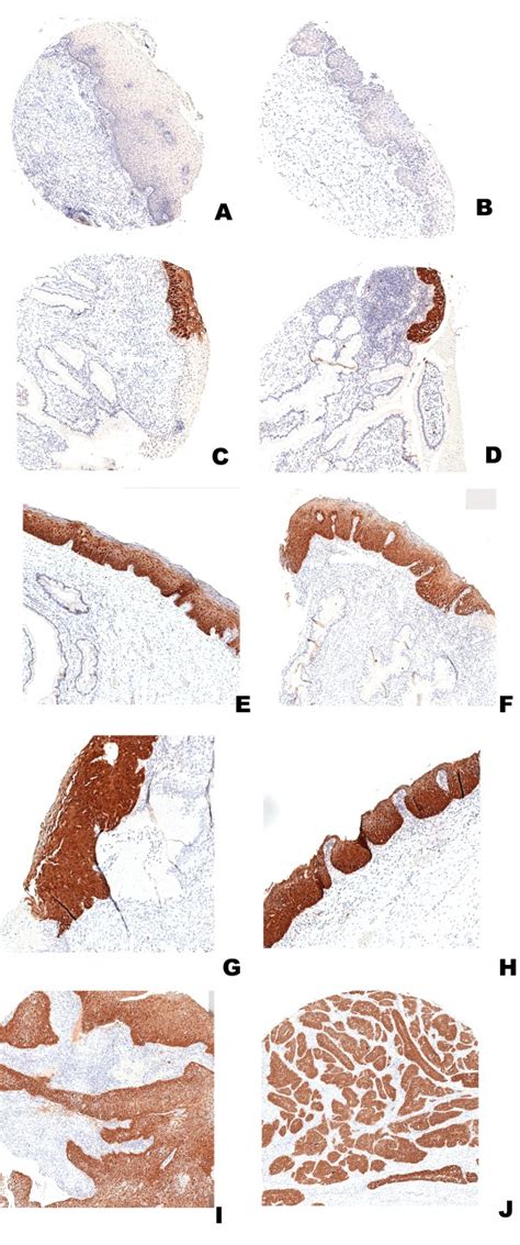 Immunohistochemical Analysis Of P16ink4a Expression Using Monoclonal