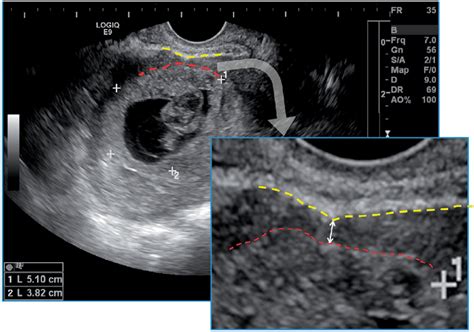 Measurement Of Minimum Thickness Of Uterine Lower Segment Myometrium