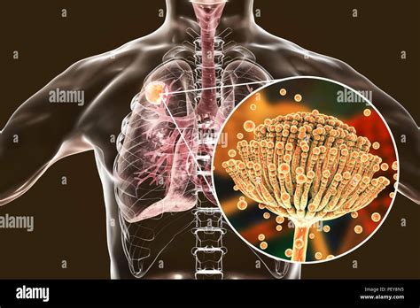 Aspergilloma of the lung and a close-up view of Aspergillus fungi ...
