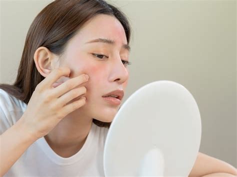 How Are Acne And The Papules And Pustules Of Rosacea Different Florida Academic Dermatology