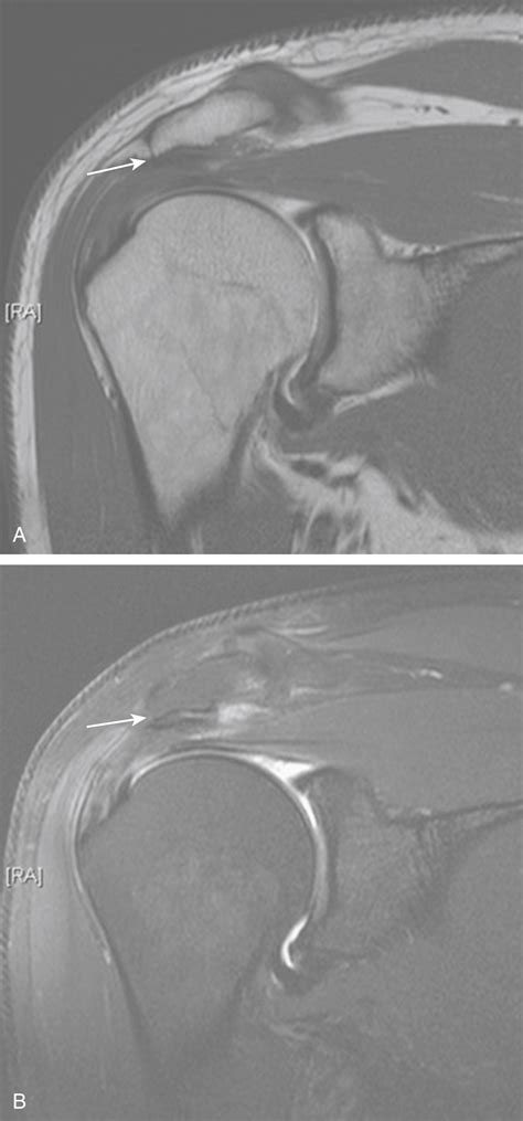 Injection Technique For Subacromial Impingement Syndrome Clinical Tree