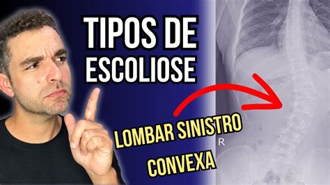 Tipos De Escoliose Youtube