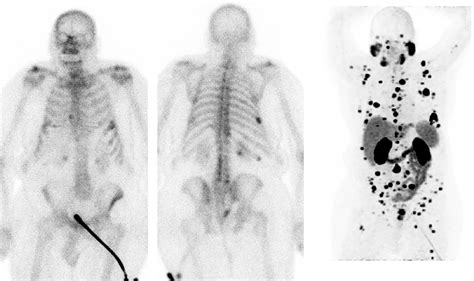 Guiding Management Of Therapy In Prostate Cancer Time To Switch From