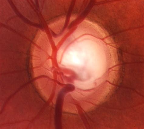 Photos Of Glaucoma Optic Nerve Cupping