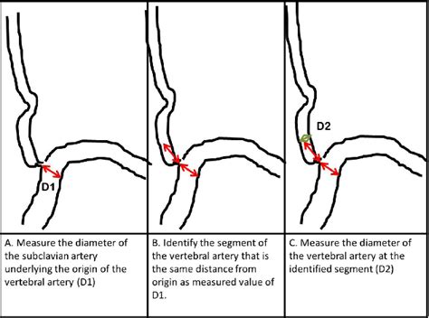 A Method For Quantifying Angiographic Severity Of Extracranial