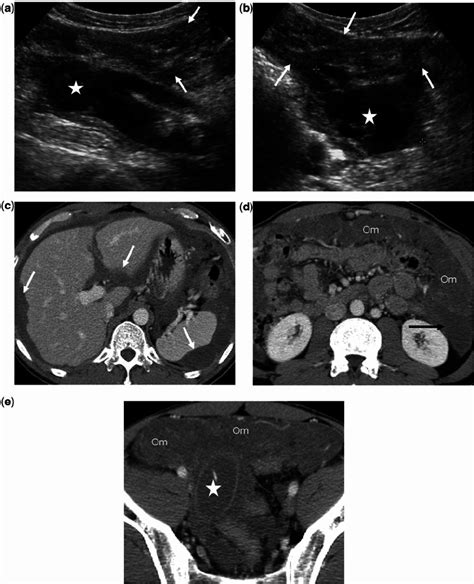 A 44-year-old man with low-grade PMP associated with an LAMN. Diagnosis ...