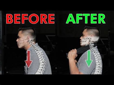 Restore your neck posture curve cervical lordosis – Artofit