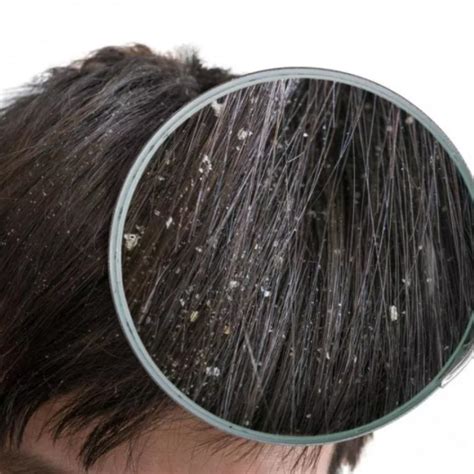 ALGAL - Как избавиться от перхоти и почему она появляется?