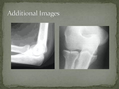 Radial Head Fracture | PPT