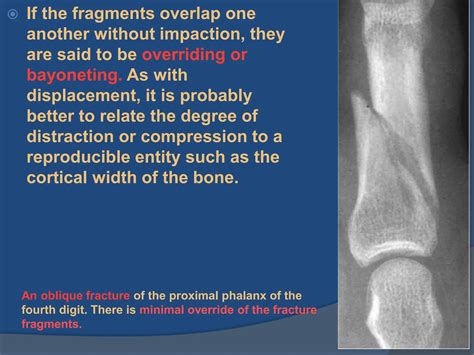 bone trauma common fractures long bone.ppt