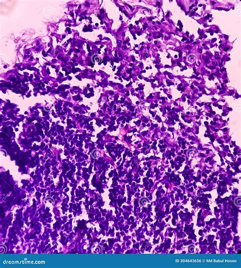 Thyroid Cancer Microscopic Image Of Metastatic Papillary Carcinoma Of