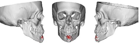 ‘Jaw in a day’ surgery the first of its kind in Alabama - News | UAB