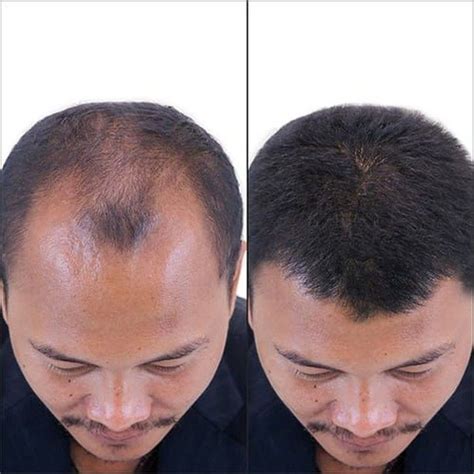 Cara Nak Cepat Nak Tumbuh Rambut Delilahjoysyang