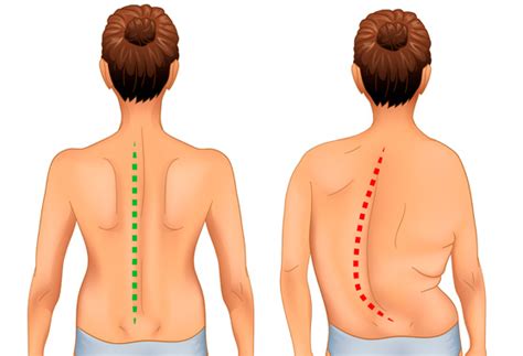 Сколиоз: лечение, причины, симптомы