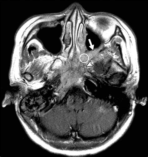 Nasopharyngeal Carcinoma Mri