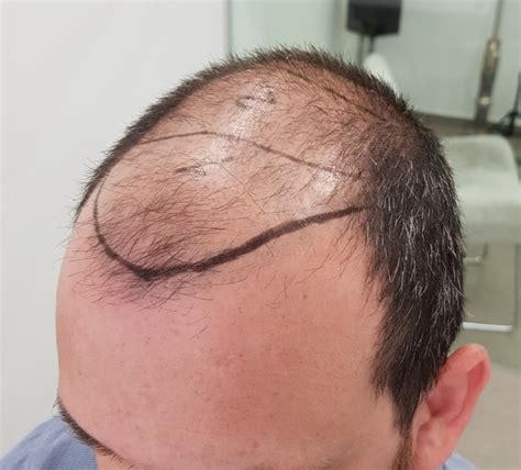 NW Class 5 Patient With 7370 FUE Grafts In Two Sessions Dr Maras