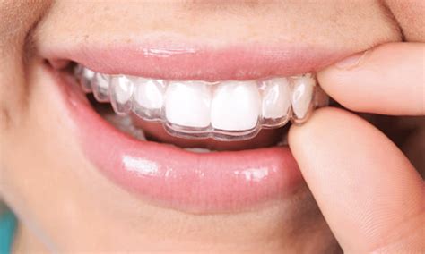 Factors To Consider Before Getting Invisalign