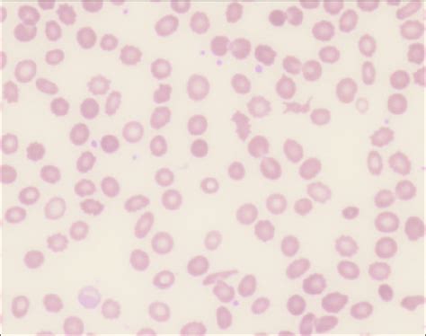 Peripheral blood smear. It shows schistocytes and reticulocytes ...