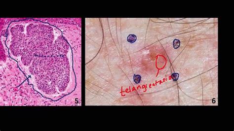 Introduction To Nmsc Skin Cancer 2 Basal Cell Cancer Bcc And