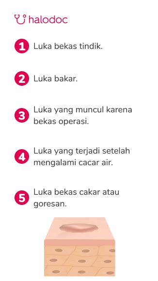 Prosedur Medis Yang Ampuh Untuk Mengatasi Keloid