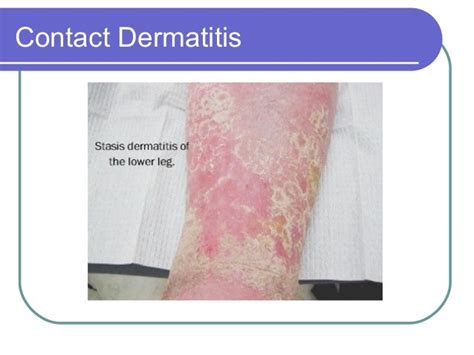 Dermatitisppt