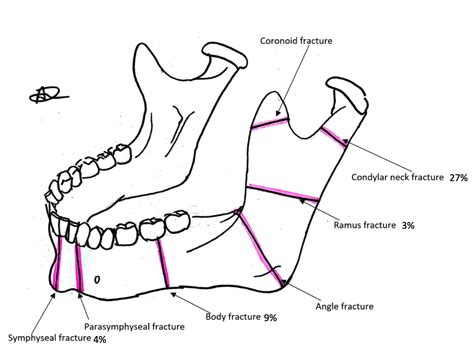 Mandibular Fractures - Revise Dental