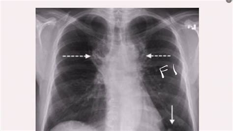 Cxr In Pe Youtube