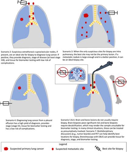 Acquiring Tissue For Advanced Lung Cancer Diagnosis And Comprehensive Biomarker Testing A