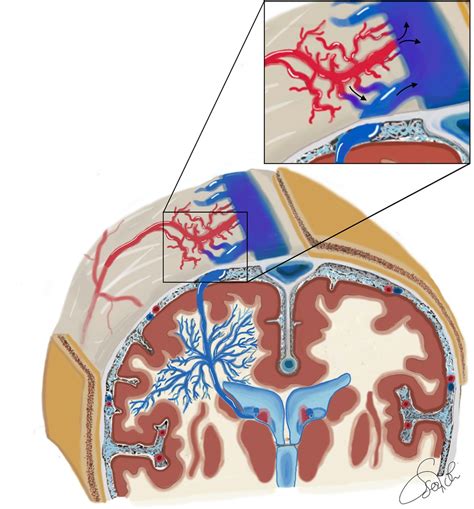 Developmental Venous Anomaly Associated With Dural Arteriovenous