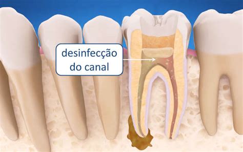 Como Feito Canal No Dente Msk Odontologia