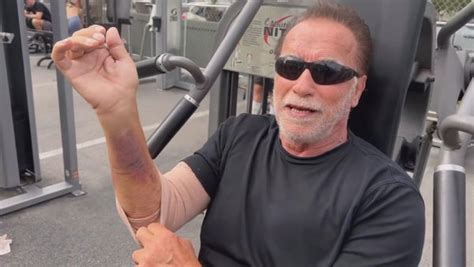 visible bruises    injured arm arnold
