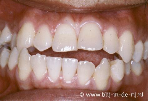 Scheve Tanden Alkmaarse Orthodontisten