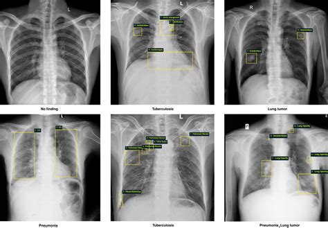 Vindr Cxr The Largest Public Chest X Ray Dataset With